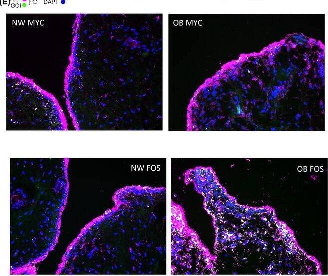 Expression dynamics of markers which distinguish normal weight and obese patient synovial fibroblasts. (A) Expression of transcriptional regulators MYC and FOS, and secretory factors INHBA and CHI3L1 along the pseudotime axis, overlaid with representation of clusters (left) and sample distribution (right) using Monocle pseudotime trajectory. Cells are ordered in pseudotime based on differentially expressed genes (q‐value < .01). (B) FeaturePlots displaying cluster specific expression of MYC, FOS, INHBA and CHI3L1 on the t‐SNE map along with violin plots showing the expression levels (y‐axis) of these markers for each cluster (x‐axis). (C and D) Median concentrations of INHBA (inhibin) and CHI3L1 in 24‐h conditioned media from normal‐weight and obese OA SF by Luminex. Bars represent median concentration in pg/ml from n = 4 patients per cohort. (E) Representative immunofluorescence imaging for c‐Fos or c‐Myc (GOI, green) in OA hip synovial tissue from normal weight (NW) and obese (OB) patients. SF were visualized with FAP (pink), and nuclei were stained with DAPI (blue), colocalization of FAP and GOI has been pseudo‐coloured (white). See Figure S10 for additional panels. (F and G) Quantification of colocalized c‐Myc or c‐Fos with FAP labelled SF. N = 8. Means plotted ± SD and analysed by student's t‐test **p < .01. Image collected and cropped by CiteAb from the following open publication (//pubmed.ncbi.nlm.nih.gov/37006170), licensed under a CC-BY license. Not internally tested by R&D Systems.