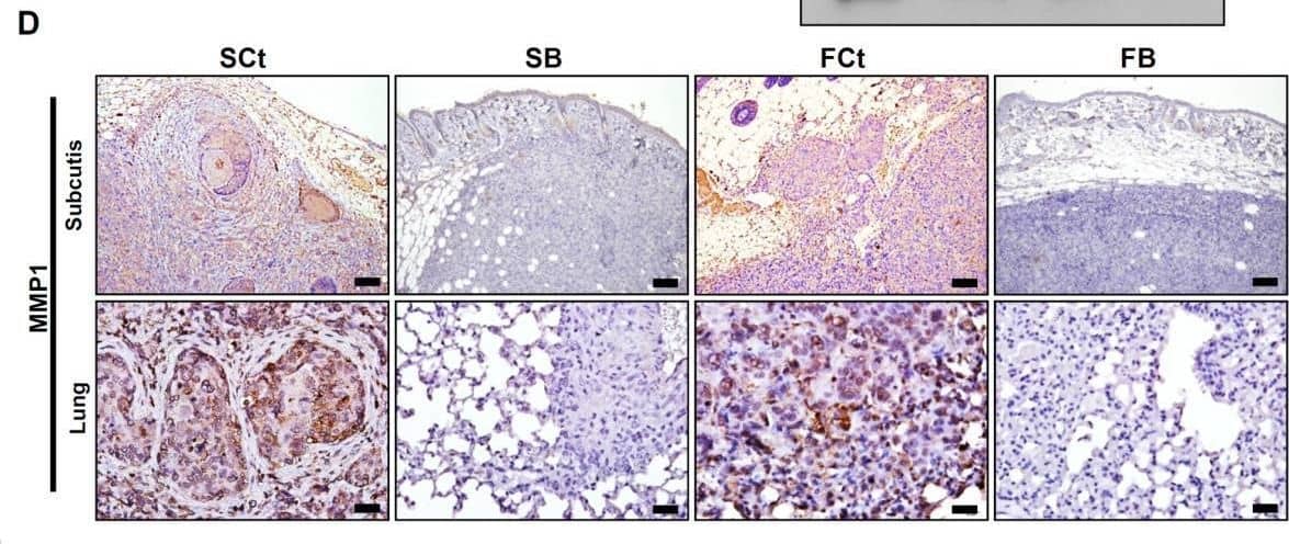 AEG-1 knockdown down-regulated MMP1 expression in HNSCC cells in vitro and in vivo. (A) microarray analysis of gene expression after AEG-1 knockdown in SAS cells. Genes with an absolute fold change greater than 2.5 are shown. SNORD3B-1, Homo sapiens small nucleolar RNA, C/D box 3B-1; EMILIN2, elastin microfibril interfacer 2; FABP4, fatty acid binding protein 4; MMP1, matrix metallopeptidase 1; ANO1, anoctamin 1; RELN, reelin; FPR2, formyl peptide receptor 2; UHMK1, U2AF homology motif kinase 1; RMND5A, required for meiotic nuclear division 5 homolog A; CAPZA1; capping protein (actin filament) muscle Z-line, alpha 1. *, p < 0.05; **, p < 0.01; ***, p < 0.001. (B) RT-QPCR confirmation of gene expression profiles after knockdown of AEG-1 in SAS and FaDu cells. All experiments were performed in triplicate (n = 3) and data were normalized to GAPDH. (C) secreted MMP1 protein in cell-conditioned culture media. Each cell lines were seeded in equal numbers (1 × 106 cells) and were cultured in starving condition (1% fetal bovine serum, FBS) for 24 hr and the media were harvested. (D) immunohistochemical staining of MMP1 in murine subcutaneous xenograft tumors (upper row) and metastatic lesions from in vivo lung metastasis assays (lower row). Scale bar: upper row, 100 μm; lower row, 25 μm. Image collected and cropped by CiteAb from the following open publication (//pubmed.ncbi.nlm.nih.gov/24063540), licensed under a CC-BY license. Not internally tested by R&D Systems.