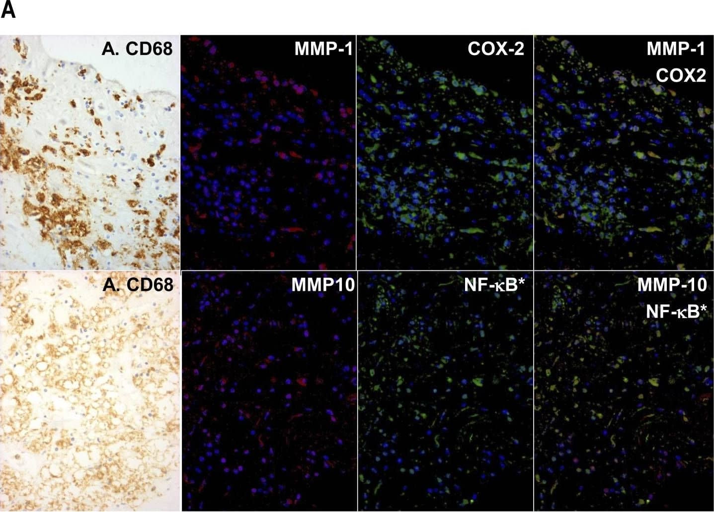 Co-localisation of MMPs with markers of classical activation in human atherosclerotic plaques.(A) Serial sections were stained by peroxidase with anti-CD68 (A. CD68) and by dual immuno-fluorescence with anti-MMP-1 or anti-MMP-10 (red) together with anti-COX-2 or p65RelA (green) as shown, and the images were superimposed digitally. Nuclear localised p65RelA (NF-kB*) was detected because of the shift in nuclear counterstain colour from dark blue (DAPI alone) to sky blue (blue plus green) in the superimposed image. (B) Areas rich in macrophages identified from the peroxidase stain were identified in the serial section. Cells in the whole field were counted and a percentage of each staining pattern calculated. Values are means ± SEM, n = 6, * p<0.05. Image collected and cropped by CiteAb from the following open publication (//pubmed.ncbi.nlm.nih.gov/22880008), licensed under a CC-BY license. Not internally tested by R&D Systems.