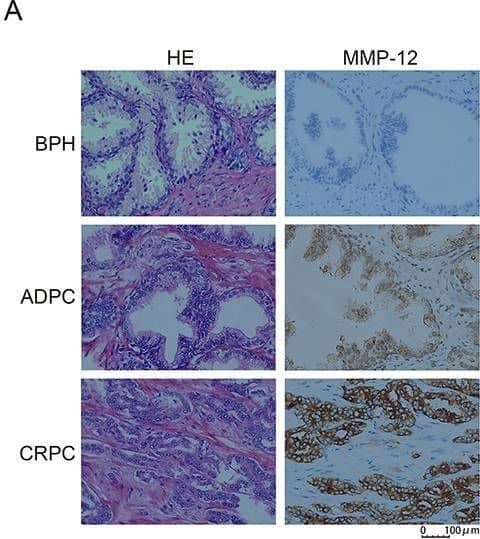 MMP-12 expression level becomes increasingly elevated as prostate cancer progresses: A, The MMP-12 protein expression (left) and quantification (right) in patients with pathological stages of benign prostatic hyperplasia (BPH), androgen-dependent prostate cancer (ADPC), and castration-resistant prostate cancer (CRPC) was determined by immunohistochemistry (scale bar 100 μm). B, The concentration of MMP-12 protein in the serum of the different groups of patients was determined by ELISA. Data are reported as means±SD. **P<0.01, ***P<0.001, and ****P<0.0001 unpaired t-test. ns: not significant. Image collected and cropped by CiteAb from the following open publication (//www.scielo.br/scielo.php?script=sci_arttext&pid=S0100-879X2024000100621&tlng=en), licensed under a CC-BY license. Not internally tested by R&D Systems.