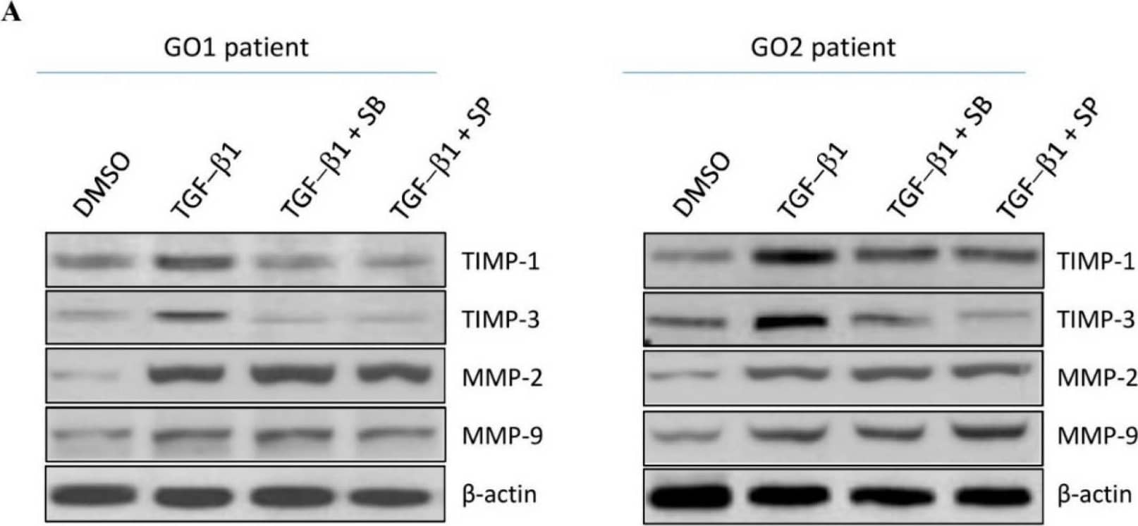 Abolishment of TGF-beta 1-mediated matrix remodeling by p38 and JNK inhibitors in the primary cultured orbital fibroblasts from patients with Graves’ ophthalmopathy (GO). (A) Orbital fibroblasts from GO patients were preincubated with the p38 inhibitor SB202190 (20 μM) and the JNK inhibitor SP600125 (20 μM), respectively, for 1 h, followed by TGF-beta 1 (5 ng/mL) treatment for another 24 h. Then, the expression levels of TIMP-1, TIMP-3, MMP-2, and MMP-9 were analyzed by Western blots; (B) The relative intensities of TIMP-1, TIMP-3, MMP-2, and MMP-9 expression normalized to each GAPDH control and DMSO control without TGF-beta 1 treatment were defined as 1.0. Then, the other relative intensity (folds) was presented. By three independent Western blot experiments, together data from the same patient strain were averaged. Then, the means of different patient (GO1–GO4, n = 4) strains were averaged; (C) The enzyme activities of MMP-2/-9 from the cultured medium were determined. The representative histogram was plotted based on the mean values of relative fluorescence units from the primary cultured orbital fibroblasts from the four GO patients. Data were presented as means ± S.D. of the results from three independent experiments. * p < 0.05 and ** p < 0.01 vs. control without TGF-beta 1 treatment; # p < 0.05 and ## p < 0.01 vs. TGF-beta 1 treatment. Image collected and cropped by CiteAb from the following open publication (//pubmed.ncbi.nlm.nih.gov/33799469), licensed under a CC-BY license. Not internally tested by R&D Systems.