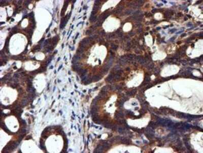 Immunohistochemistry: midA Antibody (OTI4A5) - Azide and BSA Free [NBP2-72681] - Staining of paraffin-embedded Adenocarcinoma of Human colon tissue using anti-midA mouse monoclonal antibody.