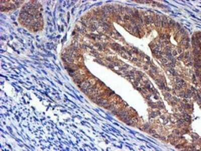 Immunohistochemistry: midA Antibody (OTI4A5) - Azide and BSA Free [NBP2-72681] - Staining of paraffin-embedded Adenocarcinoma of Human endometrium tissue using anti-midA mouse monoclonal antibody.