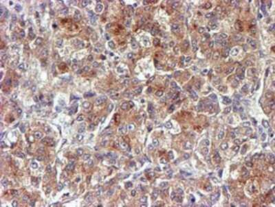 Immunohistochemistry: midA Antibody (OTI4A5) - Azide and BSA Free [NBP2-72681] - Staining of paraffin-embedded Carcinoma of Human liver tissue using anti-midA mouse monoclonal antibody.