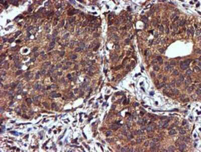 Immunohistochemistry: midA Antibody (OTI4A5) - Azide and BSA Free [NBP2-72681] - Staining of paraffin-embedded Carcinoma of Human lung tissue using anti-midA mouse monoclonal antibody.