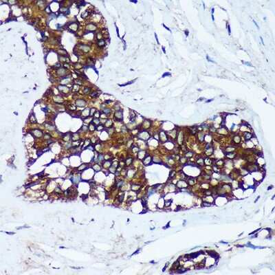 Immunohistochemistry-Paraffin: mitochondrial ribosomal protein L30 Antibody [NBP3-03295] - Immunohistochemistry of paraffin-embedded Human breast cancer using mitochondrial ribosomal protein L30 Rabbit pAb (NBP3-03295) at dilution of 1:100 (40x lens).
