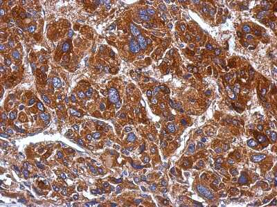 Immunohistochemistry-Paraffin: mtRNA polymerase Antibody [NBP2-19436] - Human hepatoma, using mtRNA polymerase antibody at 1:500 dilution. Antigen Retrieval: Trilogy™ (EDTA based, pH 8.0) buffer, 15min. 