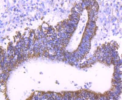 Immunohistochemistry-Paraffin: mtTFA Antibody (JM32-44) [NBP2-75577] - Analysis of paraffin-embedded human colon cancer tissue using anti-mtTFA antibody. Counter stained with hematoxylin.