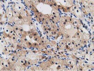 Immunohistochemistry-Paraffin: mu Crystallin Antibody (1G7) [NBP2-02829] - Staining of paraffin-embedded Carcinoma of Human kidney tissue using anti-mu Crystallin mouse monoclonal antibody.