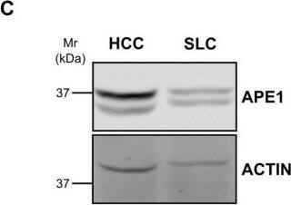 Western Blot: APE Antibody - BSA Free [NB100-101] - APE1 expression in HCC tissues(A) qPCR of tumor (HCC), peri-HCC, & surrounding liver cirrhosis (SLC), & normal liver (CTRL) (left panel). Ratio between HCC & SLC & HCC & peri-HCC within the same patients (right panel). APE1 mRNA quantification was normalized to two reference genes 18srRNA & Actin. Bar graphs indicate mean & SEM. (B) APE1 protein quantification in HCC & SLC tissue lysates from HCC cancer patients. Graphs indicate the different distributions of the fold of protein expression for each sample as the ratio between APE1 & actin. (see Supplementary Figure 1). *P < 0.05. (C) Western blot analysis of HCC & SLC tissue lysates patients performed on pooled samples from HCC cancer. Actin was used as loading control & for the relative normalization. A representative image of western blot analysis is shown. Data represent the means of ± SD of three independent experiments. *P < 0.05. (D) Immunohistochemistry of HCC, SLC, & normal (CTRL) tissue. Red & yellow arrows indicate nuclear & cytoplasmic positivity, respectively. (E) Scan of HCC nodules & its corresponding sAPE1 from 3 patients representing for each low, median, & high sAPE1. Image collected & cropped by CiteAb from the following publication (//pubmed.ncbi.nlm.nih.gov/30719231), licensed under a CC-BY license. Not internally tested by Novus Biologicals.