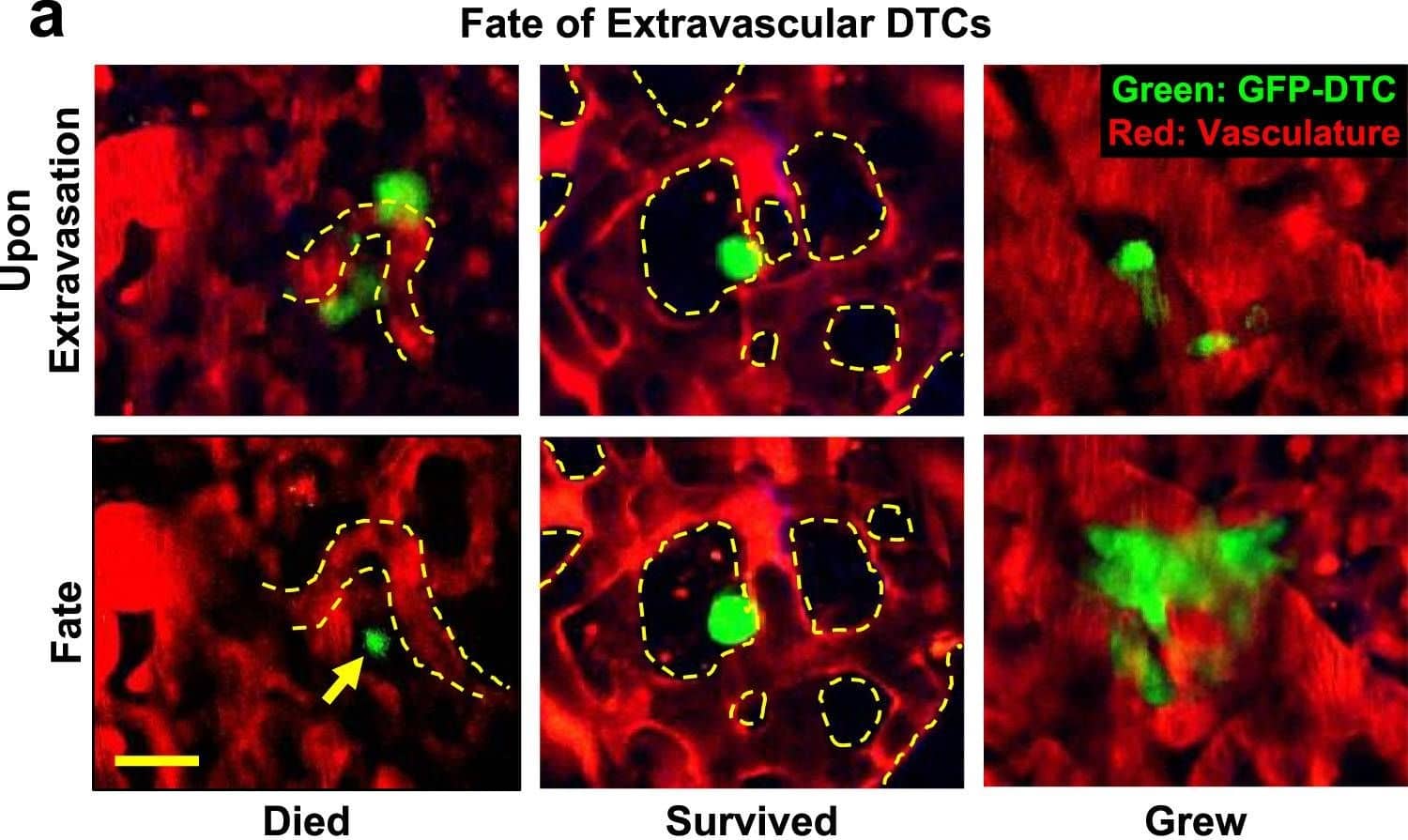 Immunocytochemistry/ Immunofluorescence: GFP Antibody [NB100-1614] - Spontaneously metastasizing tumor cells survive significantly longer at the secondary site compared to intravenously injected tumor cells.a Representative intravital microscopy images showing the possible fates of extravascular disseminated tumor cells in the lung parenchyma. Top: Images of disseminated tumor cells just after extravasation. Bottom left: Example of an extravascular tumor cell, which has died, as evidenced by small extravascular apoptotic bodies (yellow arrow). Bottom middle: Example of an extravascular tumor cell that survived as a single & solitary tumor cell over time. Bottom right: Example of an extravascular tumor cell that began to divide & grow into a micro-metastasis. Red = tdTomato labeled endothelial cells & 155 kDa Tetramethylrhodamine dextran labeled blood serum, Green = GFP labeled tumor cells. Yellow dashed lines delineate blood vessel boundaries. Scale bar = 15 μm. b Percentage of extravascular E0771-GFP disseminated tumor cells that died, survived, or grew after extravasation in EM & SM models 64 hrs after arrival to the lung vasculature. EM: n = 27 tumor cells in 4 mice. SM: n = 31 tumor cells in 4 mice. Bar = mean. Error bars = ±SEM. For Died & Survived columns, a two-tailed unpaired t-test was used (p = 0.0003 & 0.0005, respectively). For Grew columns, a two-tailed Mann-Whitney test was used (p = 0.14). ***p < 0.001. ns = not significant. Source data are provided as a Source Data file. Image collected & cropped by CiteAb from the following publication (//pubmed.ncbi.nlm.nih.gov/35110548), licensed under a CC-BY license. Not internally tested by Novus Biologicals.