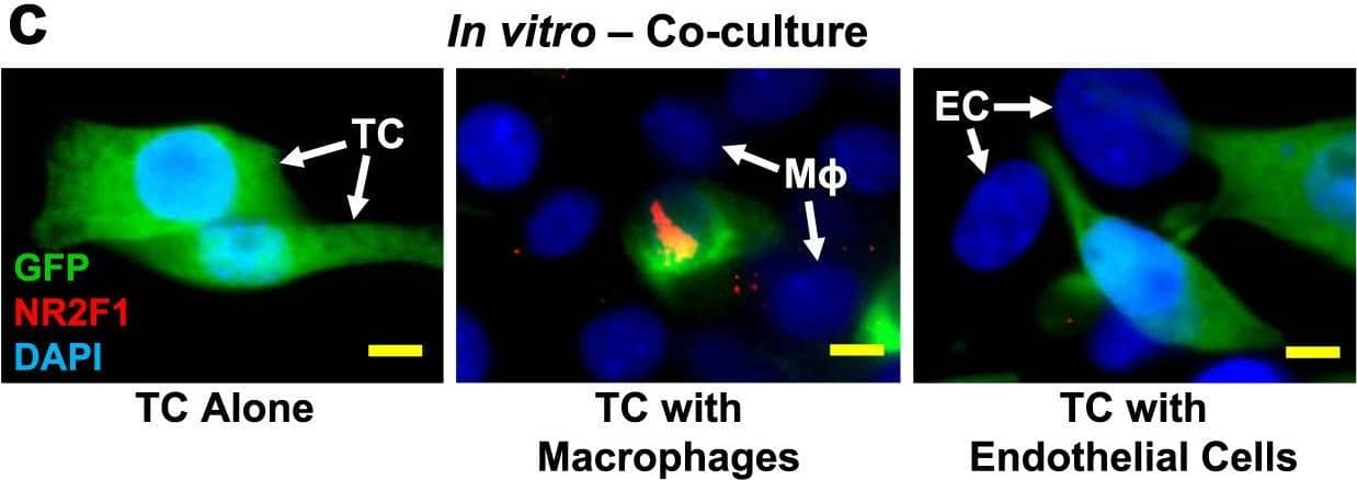 Immunocytochemistry/ Immunofluorescence: GFP Antibody [NB100-1614] - Macrophages regulate dormancy in tumor cells.a Representative image of triple immunofluorescently stained in E0771-GFP primary tumor tissue for tumor cells, macrophages, & NR2F1. Green = GFP; Red = NR2F1; White = IBA-1; Blue = DAPI. White arrow shows a macrophage. The yellow arrow contact between an NR2F1-positive tumor cell & a macrophage. Mϕ=Macrophage. Scale bar=20 μm. b Quantification showing frequency of distances between NR2F1+ tumor cells to nearest macrophage in primary tumor. Data is normalized to frequency of distances between all DAPI+ nuclei to nearest TMEM. Bar = mean. Error bars = ±SEM. n = 34 fields of view (551 × 316 µm2) in 4 animals. For comparison between 0 & 200 µm bins a two-tailed Mann-Whitney test used (p < 0.0001). ****p < 0.0001. c Representative immunofluorescence images of NR2F1 expression in E0771-GFP tumor cells cultured alone, in direct contact w/ BAC1.2F5 macrophages,/in direct contact w/ HUVEC endothelial cells. White arrows show macrophages/endothelial cells in direct contact w/ a tumor cell. Green = GFP; Red = NR2F1; Blue = DAPI. TC = Tumor Cell. Mϕ = Macrophage. EC = Endothelial Cell. Scale bar = 15 μm. d Percentage of NR2F1-positive tumor cells from each group in C. TC alone: n = 777 cells in 9 independent experiments; TC+Mϕ; n = 226 cells in 6 independent experiments, TC+EC = n = 359 cells in 4 independent experiments. Bar = mean. Error bars = ±SEM. For TC vs. TC+Mϕ (p = 0.0039), & for TC vs. TC+EC (p = 1), a two-tailed Kruskal-Wallis test w/ Dunn’s multiple comparisons adjustment used. For TC+Mϕ vs. TC+EC (0.012), a two-tailed one-way ANOVA w/ Sidak’s multiple comparison adjustment used. *p < 0.05. **p < 0.01; ns = not significant. Source data are provided as a Source Data file. Image collected & cropped by CiteAb from following publication (//pubmed.ncbi.nlm.nih.gov/35110548), licensed under a CC-BY license. Not internally tested by Novus Biologicals.