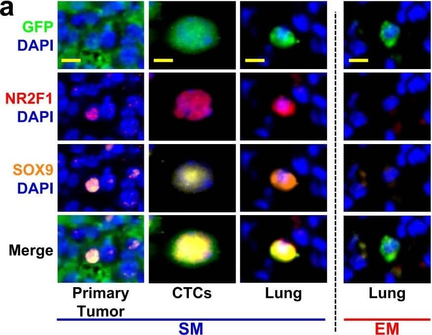 Immunocytochemistry/ Immunofluorescence: GFP Antibody [NB100-1614] - Spontaneously metastasizing tumor cells are more frequently doubly positive for dormancy & stem-like markers compared to intravenously injected tumor cells.a Representative images of triple immunofluorescence staining for GFP, NR2F1, & SOX9 expression in primary tumors, circulating tumor cells (CTCs), & disseminated tumor cells (Lung) from an E0771-GFP SM model (Left) & in disseminated tumor cells (Lung) from an EM model (Right). Green = GFP; Red = NR2F1; Orange = SOX9; Blue = DAPI. Scale bar for Primary Tumor = 50 μm. Scale bar for CTCs & Lung = 15 μm. b Percentage of double-positive tumor cells NR2F1-positive SOX9High from each group in Fig. 5a. Primary Tumor: n = 2383 in 97 fields of view (65 × 65 µm2) in 7 animals; CTCs: n = 379 cells in 8 animals; SM Lung: n = 104 cells in 9 animals; In vitro: n = 413 cells in 3 independent experiments. EM Lung: n = 75 cells in 7 animals. Bar = mean. Error bars = ±SEM. For EM Lung vs. SM Lung (p = 0.0001) & EM Lung vs. in vitro (p = 0.69), a two-tailed Kruskal-Wallis test with Dunn’s multiple comparisons adjustment was used. For PT vs. CTC: (p = 0.0041), PT vs. Lung SM (p = 0.0030), & CTC vs. Lung SM (p = 1.00) a two-tailed ANOVA test with Sidak’s multiple comparisons adjustment was used. **p < 0.01. ***p < 0.001. ns = not significant. Source data are provided as a Source Data file. Image collected & cropped by CiteAb from the following publication (//pubmed.ncbi.nlm.nih.gov/35110548), licensed under a CC-BY license. Not internally tested by Novus Biologicals.