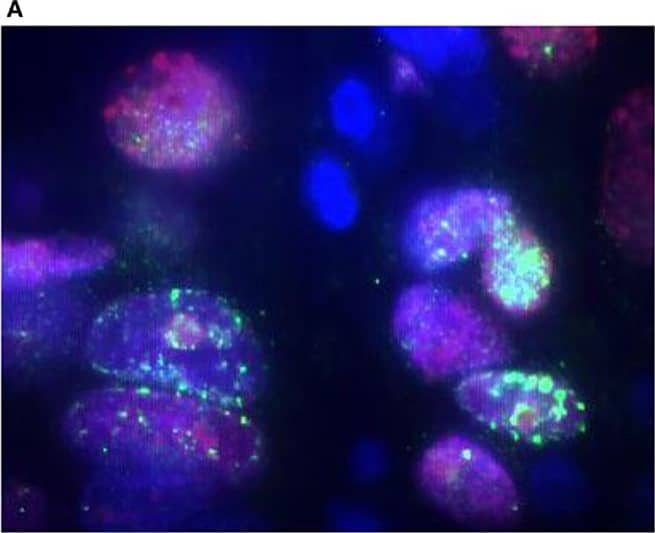 Detection of FANCD2 foci formation in human lung tumors by the FATSI staining analysis. The paraffin-embedded lung tumor tissues sections were deparaffinized and rehydrated. The tissue sections were incubated with a primary antibody cocktail of rabbit polyclonal FANCD2 antibody (Novus Biologicals, Littleton, CO, USA) at a dilution of 1:1000 and a monoclonal anti-Ki67 mouse antibody (Dako, Carpenteria, CA, USA) at a dilution of 1:150 for 1 h at room temperature. Sections then were incubated with a secondary antibody cocktail containing FITC conjugated anti-rabbit IgG and Alexafluor 594 donkey anti-mouse secondary for 1 h at room temperature. The sections were mounted on glass slides using a 4′ 6-diamidino-2-phenylindole (DAPI)-containing embedding medium (Vysis Dapi 1, Abbott Laboratories, Downers Grove, IL, USA). The slides were analyzed under a fluorescence microscope. (A) FANCD2 foci positive NSCL tumor, and (B) FANCD2 foci negative NSCL tumor. Magnification: 1000×. Image collected and cropped by CiteAb from the following open publication (//pubmed.ncbi.nlm.nih.gov/25566506), licensed under a CC-BY license. Not internally tested by Novus Biologicals.