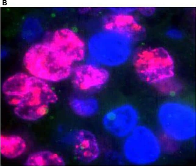 Detection of FANCD2 foci formation in human lung tumors by the FATSI staining analysis. The paraffin-embedded lung tumor tissues sections were deparaffinized and rehydrated. The tissue sections were incubated with a primary antibody cocktail of rabbit polyclonal FANCD2 antibody (Novus Biologicals, Littleton, CO, USA) at a dilution of 1:1000 and a monoclonal anti-Ki67 mouse antibody (Dako, Carpenteria, CA, USA) at a dilution of 1:150 for 1 h at room temperature. Sections then were incubated with a secondary antibody cocktail containing FITC conjugated anti-rabbit IgG and Alexafluor 594 donkey anti-mouse secondary for 1 h at room temperature. The sections were mounted on glass slides using a 4′ 6-diamidino-2-phenylindole (DAPI)-containing embedding medium (Vysis Dapi 1, Abbott Laboratories, Downers Grove, IL, USA). The slides were analyzed under a fluorescence microscope. (A) FANCD2 foci positive NSCL tumor, and (B) FANCD2 foci negative NSCL tumor. Magnification: 1000×. Image collected and cropped by CiteAb from the following open publication (//pubmed.ncbi.nlm.nih.gov/25566506), licensed under a CC-BY license. Not internally tested by Novus Biologicals.
