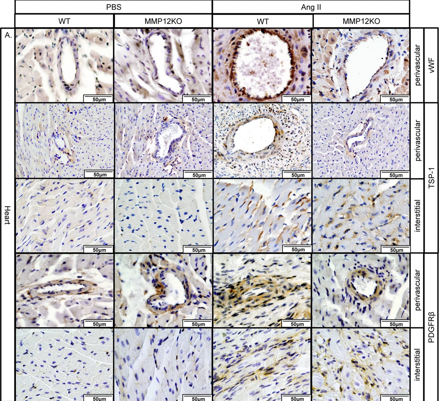 Immunohistochemistry-Paraffin: Thrombospondin-1 Antibody (A6.1) [NB100-2059] - Reduced levels of vascular & pericyte markers in MMP12KO mice.A. IHC staining of vWF, TSP-1 & PDGFR beta  was performed on paraffin sections from the heart of PBS & Ang II treated WT & MMP12KO mice. B. IHC staining of vWF, & PDGFR beta  was performed on paraffin sections from the skin of PBS & Ang II treated WT & MMP12KO mice. Representative photographs are shown from three animals per group. Image collected & cropped by CiteAb from the following publication (//dx.plos.org/10.1371/journal.pone.0109763), licensed under a CC-BY license. Not internally tested by Novus Biologicals.