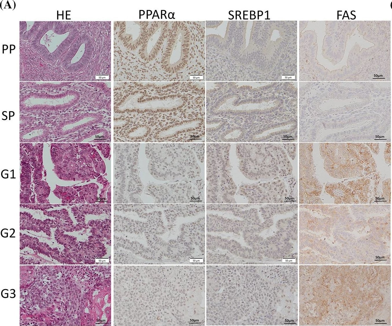 Western Blot: SREBP1 Antibody - BSA Free [NB100-2215] - MiR-181a overexpression impairs & miR-181a inhibition improves glucose & lipid homeostasis in HepG2 cellsHepG2 cells were divided into 4 groups as follows: a control group, mimics group (HepG2 cells transfected with 10 nM mimics), NEFA group (treated with 1.2 mM NEFA), & miR-181a + NEFA group (transfected with 50 nM miR-181a inhibitors & then treated with 1.2 mM NEFA). B was followed with or without 100 nM insulin. (A) Immunoblot analysis (top) & quantification (bottom) of SIRT1, PGC-1 alpha  & acetylated PGC-1 alpha  in HepG2 cells. (B) Immunoblotting analysis (top) & quantification (bottom) of insulin-stimulated phosphorylation of AKT in HepG2 cells. (C) Glucose concentration in medium. (D) The glycogen content in HepG2 cells. (E) The mRNA expression levels of G6Pase & PEPCK. (F) Immunoblot analysis (left) & quantification (right) of SREBP-1c & PPAR alpha  in HepG2 cells. (G) TG content in HepG2 cells. *P 25 (n = 24). There was no significant difference. (F) The BMI and H-scores of PPAR alpha , SREBP1, and FAS in each EMC patient are shown in scatter plots. Spearman’s rank correlation coefficient showed a weak inverse correlation between BMI and the PPAR alpha  H-score and a moderate or weak correlation between BMI and SREBP1 or FAS. Image collected and cropped by CiteAb from the following open publication (//pubmed.ncbi.nlm.nih.gov/37305395), licensed under a CC-BY license. Not internally tested by Novus Biologicals.