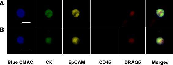 Representative images of CTCs isolated from breast cancer patient whole blood. Blood sample was kept at room temperature for 6 days and processed as described in the text. Rows a and b (from left to right) show images of captured CTCs stained for viability using Blue CMAC (blue), cytokeratin (CK) staining (green), EpCAM staining (yellow), Alexa Fluor 594 CD45 staining (olive), DNA staining (red) and merged figures, respectively. Bars indicate 20 μm