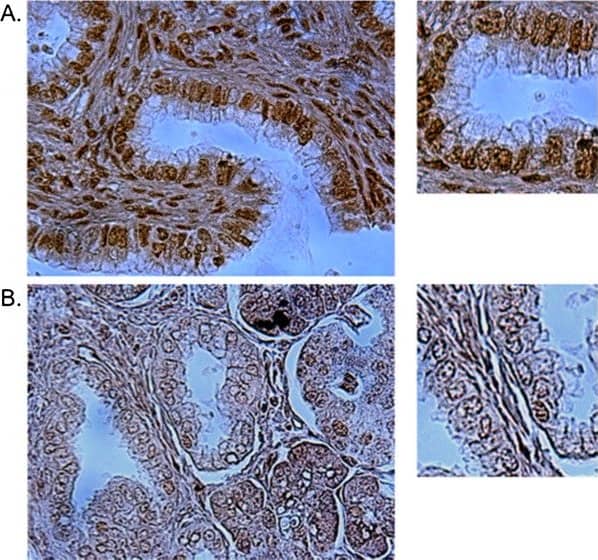 Immunohistochemistry: 53BP1 Antibody - BSA Free [NB100-304] - Representative immunohistochemistry staining for 53BP1 expression in pancreatic adenocarcinoma. (A) is high intensity of 53BP1 expression & (B) is low intensity of 53BP1 expression. Image collected & cropped by CiteAb from the following publication (//pubmed.ncbi.nlm.nih.gov/23530749), licensed under a CC-BY license. Not internally tested by Novus Biologicals.