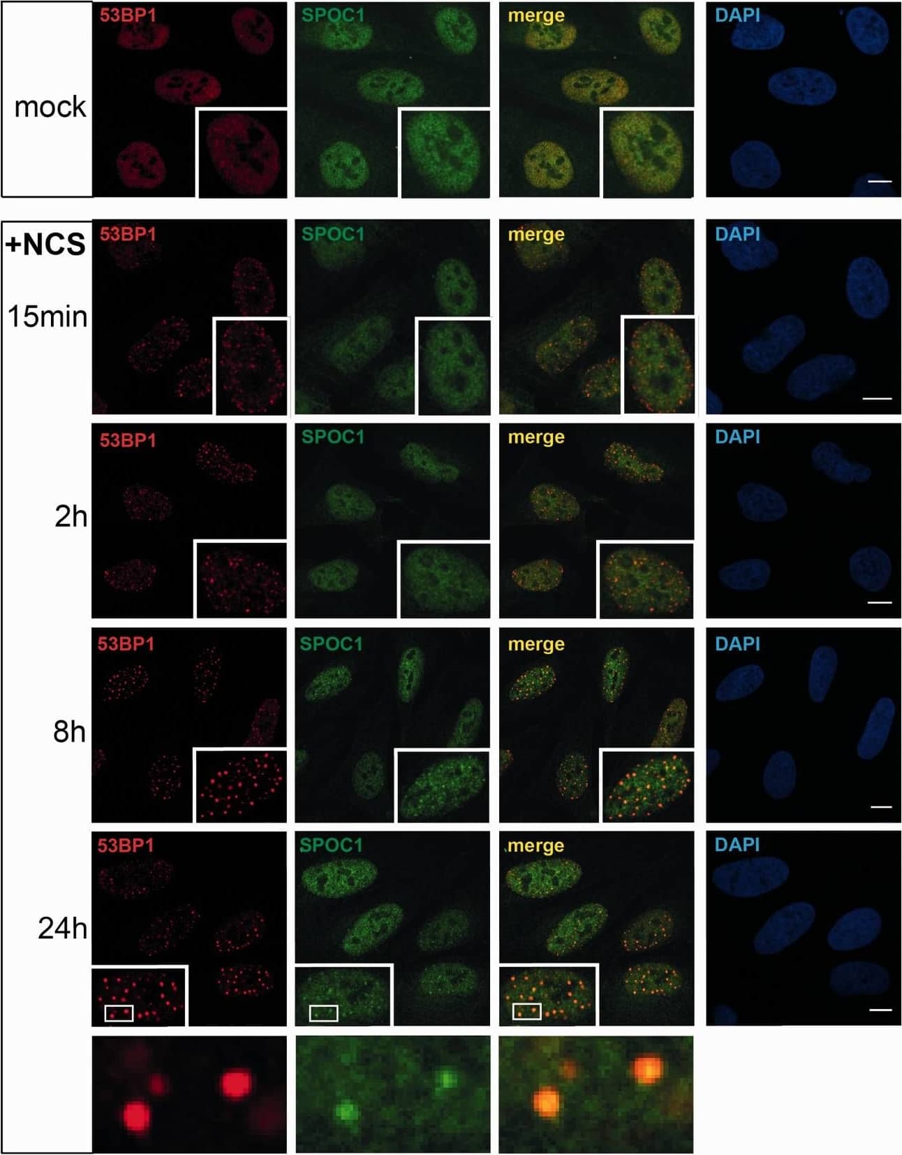 Immunocytochemistry/ Immunofluorescence: 53BP1 Antibody - BSA Free [NB100-304] - Comparative kinetics of 53BP1 & SPOC1 recruitment to radiomimetic drug NCS-induced DSBs. U2OS cells fixed before (mock) or at the indicated times post-treatment (+NCS), immunostained for SPOC1 (green) & 53BP1 (red) & analyzed by confocal microcopy. At the earliest observation period after NCS treatment (15 min) a large number of small 53BP1 stained DSB repair foci emerged, but were not detectably stained by SPOC1. Between 2 to 24 h post-NCS treatment the number of small 53BP1 stained foci gradually, then almost completely disappeared, concomitant with emerging larger repair foci. At around 8 h post-NCS treatment most of the large 53BP1-stained repair foci were also strongly stained by SPOC1, suggesting SPOC1 is recruited to & accumulates at DSBs in heterochromatin known for their slow repair kinetics. Scale bars = 10µm. Image collected & cropped by CiteAb from the following publication (//academic.oup.com/nar/article-lookup/doi/10.1093/nar/gks868), licensed under a CC-BY license. Not internally tested by Novus Biologicals.