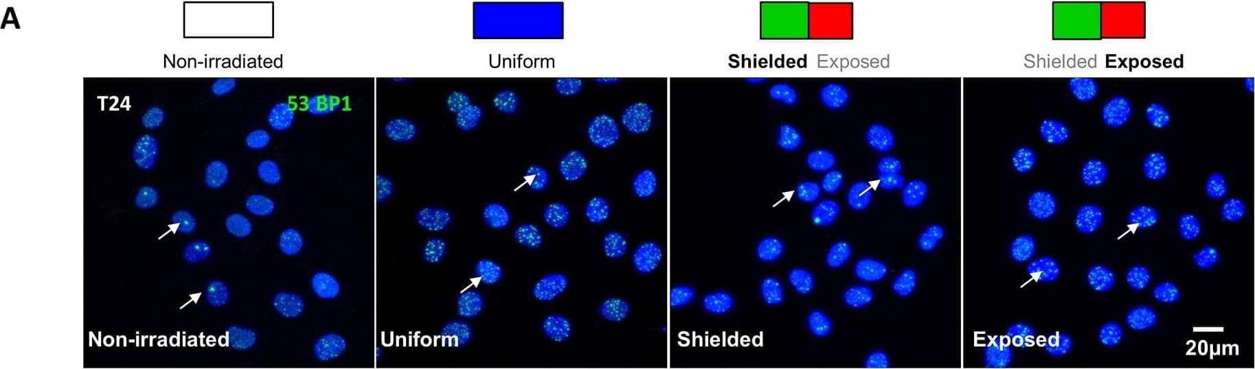 Immunocytochemistry/ Immunofluorescence: 53BP1 Antibody - BSA Free [NB100-304] - Bystander signaling evokes DNA damage foci formation in urothelial cancer & normal urothelial cells(A) Schematic representation of experimental conditions including non-irradiated, uniformly-irradiated & shielding protocols where 50% of the slide was exposed & 50% shielded with MCP alloy. Cells were fixed & processed for 53BP1-immunofluorescence, one hour following irradiation. Micrographs of urothelial cancer T24 cells labelled with anti-53BP1 (green) to label nuclear DNA double stand break foci & DAPI to counterstain nuclei are shown for each experimental condition. (B) Summary graph of mean foci/cell in T24 cells (N=3), measured from confocal z-stacks in Volocity software. There were significantly more foci in shielded cells 0.5mm from the shield than in non-irradiated controls, indicative of a bystander effect (p=0.019). (C) Summary data for HT1376 cancer cells (N=3) where there was no difference in the mean foci/cell between non-irradiated controls & shielded cells. (D) Summary data for normal urothelial HUC (N=3). Mean foci/cell was significantly greater in shielded cells in the 0-5mm (p=0.005) & 5-10mm (p=0.04) analysis regions from the shield. * denotes p<0.05, ** denotes p<0.01 Image collected & cropped by CiteAb from the following publication (//pubmed.ncbi.nlm.nih.gov/29228614), licensed under a CC-BY license. Not internally tested by Novus Biologicals.