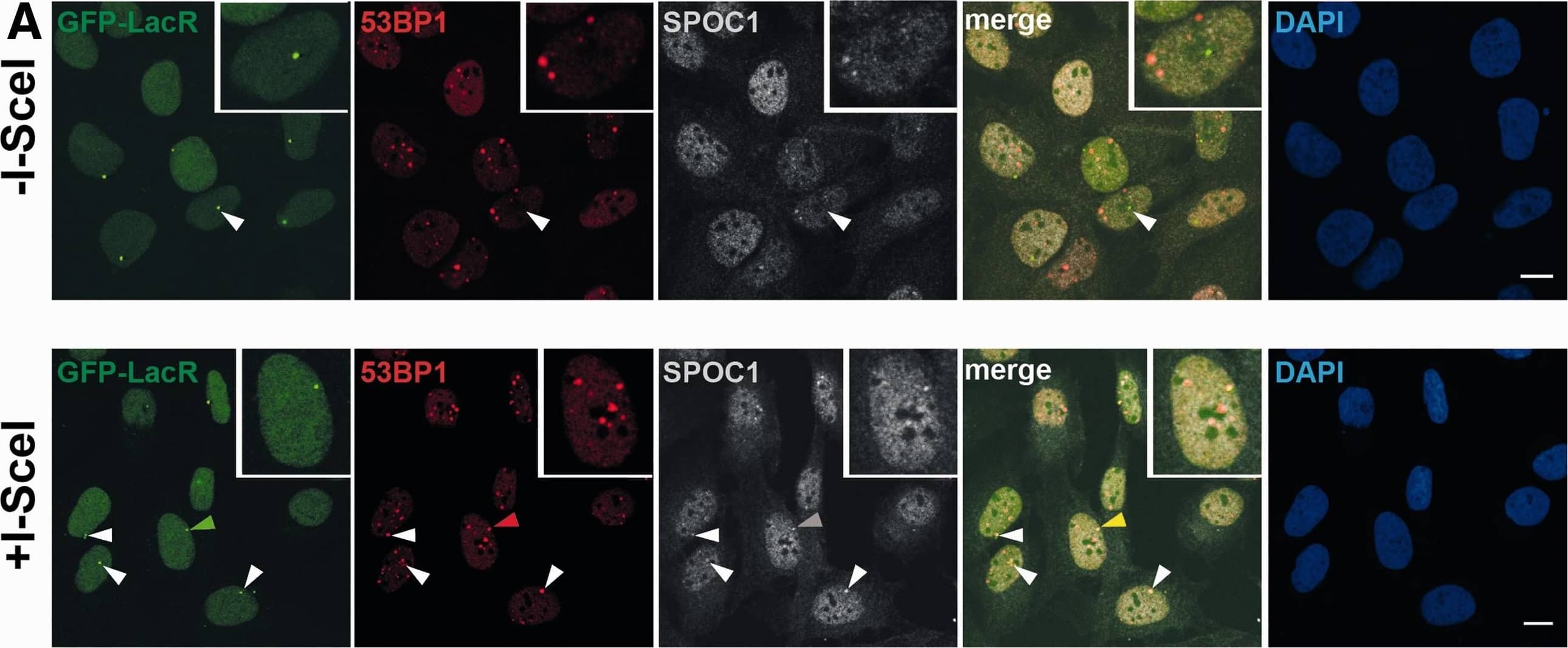Immunocytochemistry/ Immunofluorescence: 53BP1 Antibody - BSA Free [NB100-304] - SPOC1 is recruited to I-SceI-induced DSBs where it colocalizes with 53BP1. (A) In situ immunofluorescence studies with U2OS19 ptight13 GFP-LacR cells with a stably integrated I-SceI cleavage site flanked by lac operator repeats reveals localization of the GFP-lac repressor protein (GFP-LacR) at the lac-operator DNA sequences in the nucleus before (−I-SceI) & 16 h after I-SceI-induced (+ I-SceI) DSB. In contrast, SPOC1 (white) & 53BP1 (red) are distributed throughout the nucleus in the absence of I-Scel, & partially colocalized in naturally occurring repair foci. After I-SceI cleavage to generate DSBs, SPOC1 & 53BP1 colocalize at distinct foci, including the cleaved DNA adjacent to DNA-bound GFP-LacR. Proteins were visualized by immunostaining & confocal microscopy. Scale bars = 10 μm. (B) Quantitative analysis of SPOC1 recruitment to the 53BP1 & GFP-LacR positive lacO array before & 16 h after I-SceI induction. (C) Monitoring of the kinetics of SPOC1 & 53BP1 recruitment to DSBs between 0 & 24 h post-I-SceI induction. (D) Quantifying ATM kinase inhibitor-mediated effects on recruitment of SPOC1 & 53BP1 to DSBs as evident 16 h after I-SceI-induced cleavage. (E) SPOC1 & 53BP1 colocalize at a large discrete endogenous repair focus as observed in some non-irradiated U2OS cells by immunostaining. Scale bar = 10µm. Image collected & cropped by CiteAb from the following publication (//academic.oup.com/nar/article-lookup/doi/10.1093/nar/gks868), licensed under a CC-BY license. Not internally tested by Novus Biologicals.