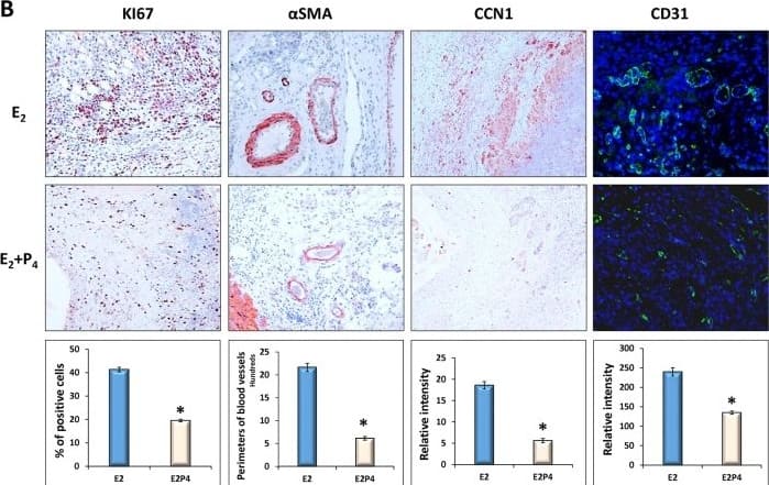 Immunocytochemistry/ Immunofluorescence: Cyr61/CCN1 Antibody - BSA Free [NB100-356] - P4 inhibits E2-dependent cell proliferation & angiogenesis in ectopic lesions.Sections of the ectopic lesions collected from E2 or E2 plus P4-treated recipients (D16, n = 6) were subjected to histological examination. (A) Representative images (20X) showing H&E & Trichrome staining, or IHC analysis using antibody against myofibroblast biomarker  alpha SMA, uterine epithelial biomarker KRT11, or uterine stromal biomarker VIM, respectively. (B) Representative images (20X) showing IHC analysis using antibodies against cell proliferation biomarker KI67, smooth muscle biomarker  alpha SMA, endothelial cells CD31, or an angiogenetic regulator CCN1, respectively. The numbers of KI67-positive cells, the perimeters of the supporting blood vessels, & the immunostaining intensities of CCN1 & CD31 were analyzed by ImageJ software. The numerical values were analyzed by One-way ANOVA followed by Dunnett’s post hoc test & expressed as mean ± SEM. Statistical significance is defined as #: p < 0.05, *: p<0.01. Image collected & cropped by CiteAb from the following publication (//dx.plos.org/10.1371/journal.pone.0165347), licensed under a CC-BY license. Not internally tested by Novus Biologicals.