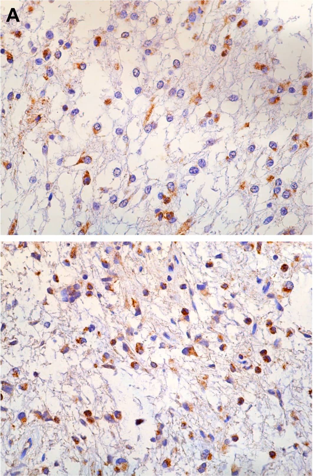 Immunohistochemistry-Paraffin: PBR Antibody [NB100-41398] - Human tumor microarrays (TMAs).Pilocytic astrocytoma TSPO immunohistochemistry (A) & TSPO immunohistochemical scoring (C). Glioblastoma multiforme TSPO immunohistochemistry (B) & TSPO immunohistochemical scoring (D). Image collected & cropped by CiteAb from the following publication (//dx.plos.org/10.1371/journal.pone.0141659), licensed under a CC-BY license. Not internally tested by Novus Biologicals.