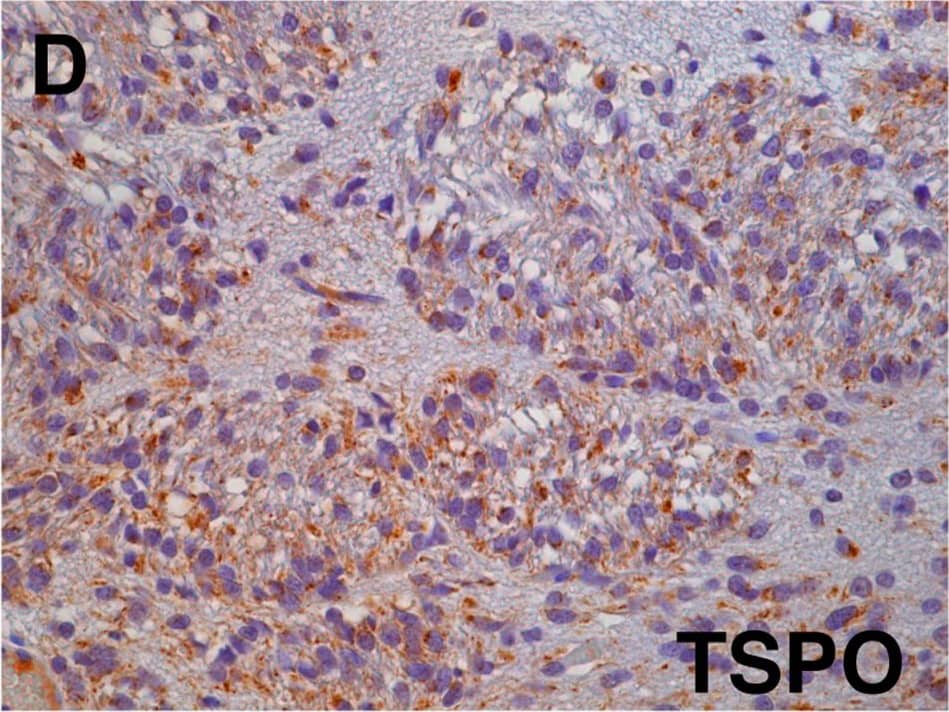 Immunohistochemistry: PBR Antibody [NB100-41398] - [18F]PBR06 selectivity in primary human grade IV glioblastoma xenotransplant.(A) Dynamic PET image (axial) pre-infusion of cold analog, with [18F]PBR06 uptake primarily confined to the tumor. (B) Dynamic PET image (axial) post-infusion, showing nearly total displacement of [18F]PBR06. (C) Time-activity curves of injected [18F]PBR06 in tumor (green) & contralateral brain (blue). (D) Correlative TSPO immunohistochemistry, Tumor + White Matter Tract (40X). Image collected & cropped by CiteAb from the following publication (//dx.plos.org/10.1371/journal.pone.0141659), licensed under a CC-BY license. Not internally tested by Novus Biologicals.
