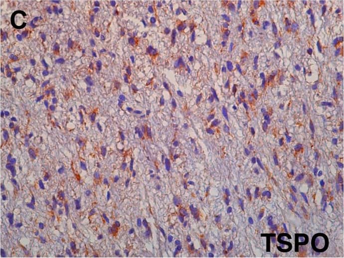 Immunohistochemistry-Paraffin: PBR Antibody [NB100-41398] - Primary human grade IV glioblastoma xenotransplant.(A) Dynamic PET image (coronal) of advanced tumor in the right hemisphere of the brain with [18F]PBR06 uptake confined primarily to the tumor. Arrows indicate tumor & infiltration into left hemisphere. (B) Time-activity curves of injected [18F]PBR06 in tumor (green) & contralateral brain (blue) [30]. (C) Correlative TSPO immunohistochemistry, Tumor + White Matter Tract (40X). Image collected & cropped by CiteAb from the following publication (//dx.plos.org/10.1371/journal.pone.0141659), licensed under a CC-BY license. Not internally tested by Novus Biologicals.