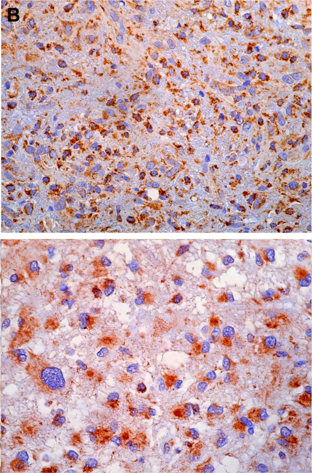 Immunohistochemistry-Paraffin: PBR Antibody [NB100-41398] - Human tumor microarrays (TMAs).Pilocytic astrocytoma TSPO immunohistochemistry (A) & TSPO immunohistochemical scoring (C). Glioblastoma multiforme TSPO immunohistochemistry (B) & TSPO immunohistochemical scoring (D). Image collected & cropped by CiteAb from the following publication (//dx.plos.org/10.1371/journal.pone.0141659), licensed under a CC-BY license. Not internally tested by Novus Biologicals.