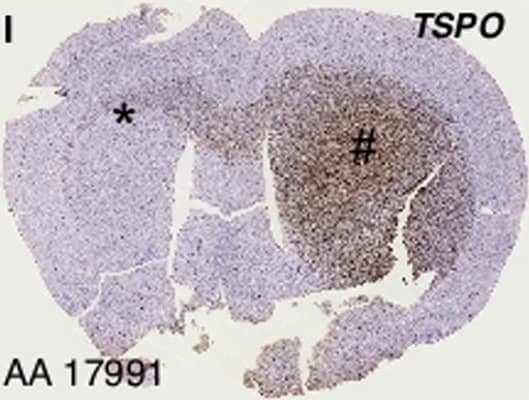Immunohistochemistry: PBR Antibody [NB100-41398] - Primary human grade III astrocytoma xenotransplant.(A) T2-weighted MRI (coronal) visualizes advanced tumor in the right hemisphere of the brain. (B) Correlative dynamic PET image (coronal) of same advanced tumor in the right hemisphere of the brain, with [18F]PBR06 uptake primarily confined to the tumor & co-localizing with tumor tissue visualized by MRI. Top arrows indicate tumor & infiltration into left hemisphere. (C) Fused MRI (A) PET (B) image. (D) Time-activity curves of injected [18F]PBR06 in tumor (green) & contralateral brain (blue). Correlative vimentin immunohistochemistry: (E) Gross; (F) Tumor + White Matter Tract (40X); (G) Tumor (40X). (H) Correlative dynamic PET image, axial view along yellow line in (B); arrows indicate tumor & infiltration into left hemisphere. Correlative TSPO immunohistochemistry: (I) Gross; (J) Tumor + White Matter Tract (40X); (K) Tumor (40X). (L) Dynamic PET image (axial) of control cohort. Correlative CD68 immunohistochemistry: (M) Gross; (N) Tumor + White Matter Tract (40X); (O) Tumor (40X). Image collected & cropped by CiteAb from the following publication (//dx.plos.org/10.1371/journal.pone.0141659), licensed under a CC-BY license. Not internally tested by Novus Biologicals.