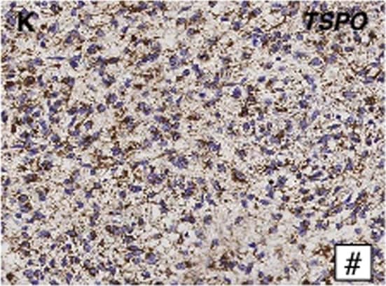 Immunohistochemistry-Paraffin: PBR Antibody [NB100-41398] - Primary human grade III astrocytoma xenotransplant.(A) T2-weighted MRI (coronal) visualizes advanced tumor in the right hemisphere of the brain. (B) Correlative dynamic PET image (coronal) of same advanced tumor in the right hemisphere of the brain, with [18F]PBR06 uptake primarily confined to the tumor & co-localizing with tumor tissue visualized by MRI. Top arrows indicate tumor & infiltration into left hemisphere. (C) Fused MRI (A) PET (B) image. (D) Time-activity curves of injected [18F]PBR06 in tumor (green) & contralateral brain (blue). Correlative vimentin immunohistochemistry: (E) Gross; (F) Tumor + White Matter Tract (40X); (G) Tumor (40X). (H) Correlative dynamic PET image, axial view along yellow line in (B); arrows indicate tumor & infiltration into left hemisphere. Correlative TSPO immunohistochemistry: (I) Gross; (J) Tumor + White Matter Tract (40X); (K) Tumor (40X). (L) Dynamic PET image (axial) of control cohort. Correlative CD68 immunohistochemistry: (M) Gross; (N) Tumor + White Matter Tract (40X); (O) Tumor (40X). Image collected & cropped by CiteAb from the following publication (//dx.plos.org/10.1371/journal.pone.0141659), licensed under a CC-BY license. Not internally tested by Novus Biologicals.