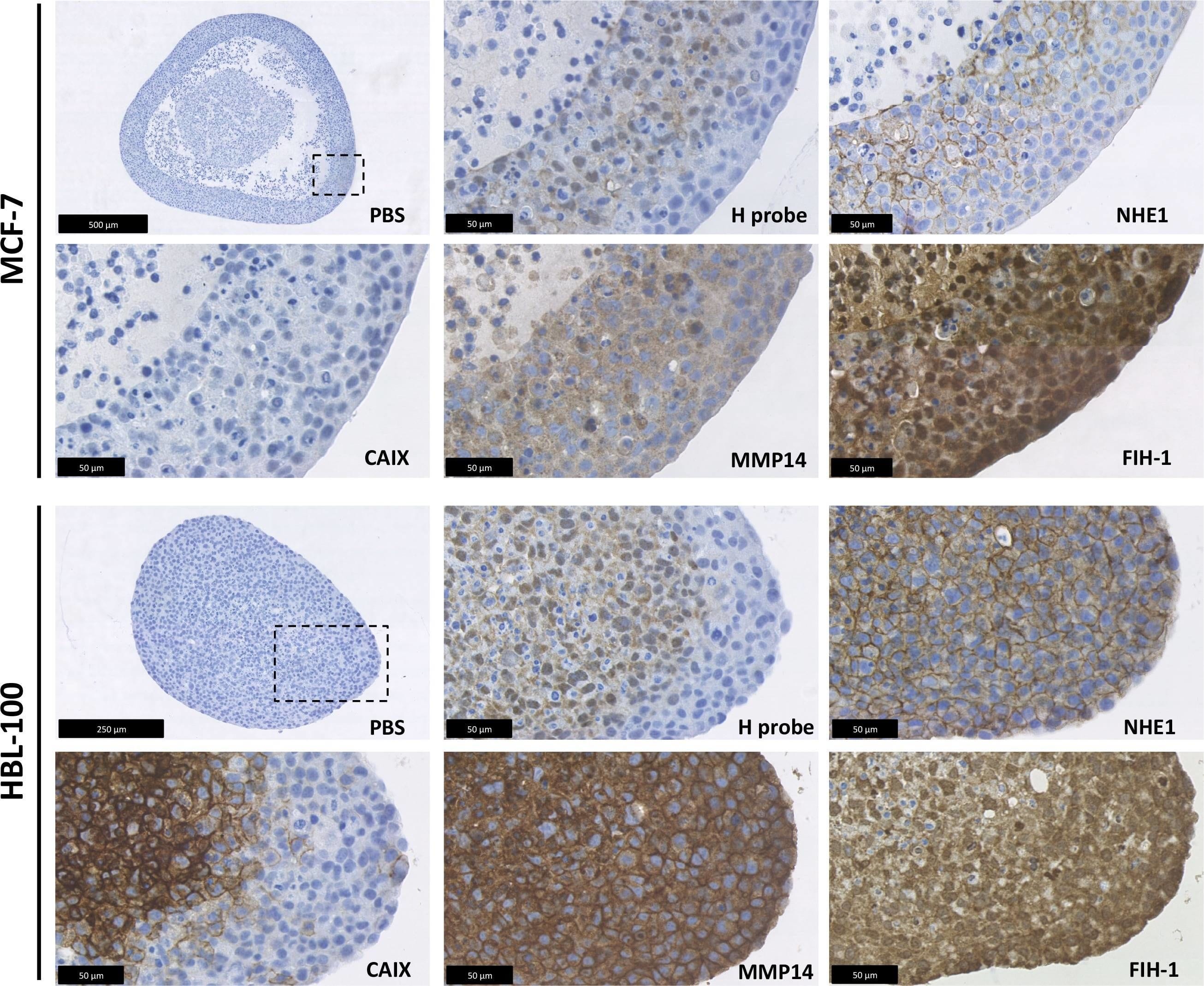 Immunohistochemistry: FIH-1/HIF-1AN Antibody [NB100-428] - 3D target protein expression in multicellular tumor spheroids3D expression analysis was carried out in the MCF-7, MDA-MB-231 & HBL-100 cell lines using multicellular tumor spheroids. The spheroids were cultured in spinner flasks for 1 week before fixation. Hypoxyprobe was used to examine the formation of hypoxic areas within the spheroids. NHE1, CAIX, MMP14 & FIH-1 expression was also analyzed. Incubation for an hour with PBS instead of primary antibody acted as a control. Image collected & cropped by CiteAb from the following publication (//www.oncotarget.com/lookup/doi/10.18632/oncotarget.17143), licensed under a CC-BY license. Not internally tested by Novus Biologicals.