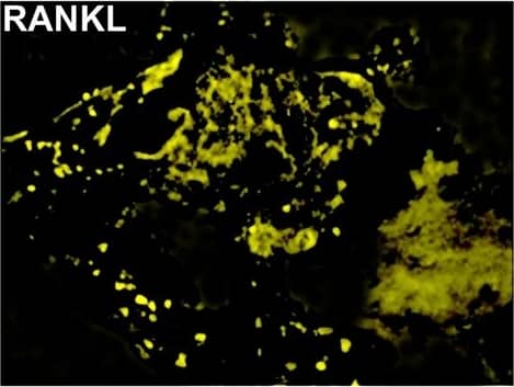 Immunocytochemistry/ Immunofluorescence: TRANCE/TNFSF11/RANK L Antibody (12A668) - BSA Free [NB100-56512] - MQDL detects EMT biomarkers in clinical bone tissue specimens.A representative specimen of human prostate cancer bone metastasis co-expressed high levels of epithelial EpCAM, & mesenchymal RANKL & vimentin proteins. ×400. Image collected & cropped by CiteAb from the following publication (//dx.plos.org/10.1371/journal.pone.0028670), licensed under a CC-BY license. Not internally tested by Novus Biologicals.