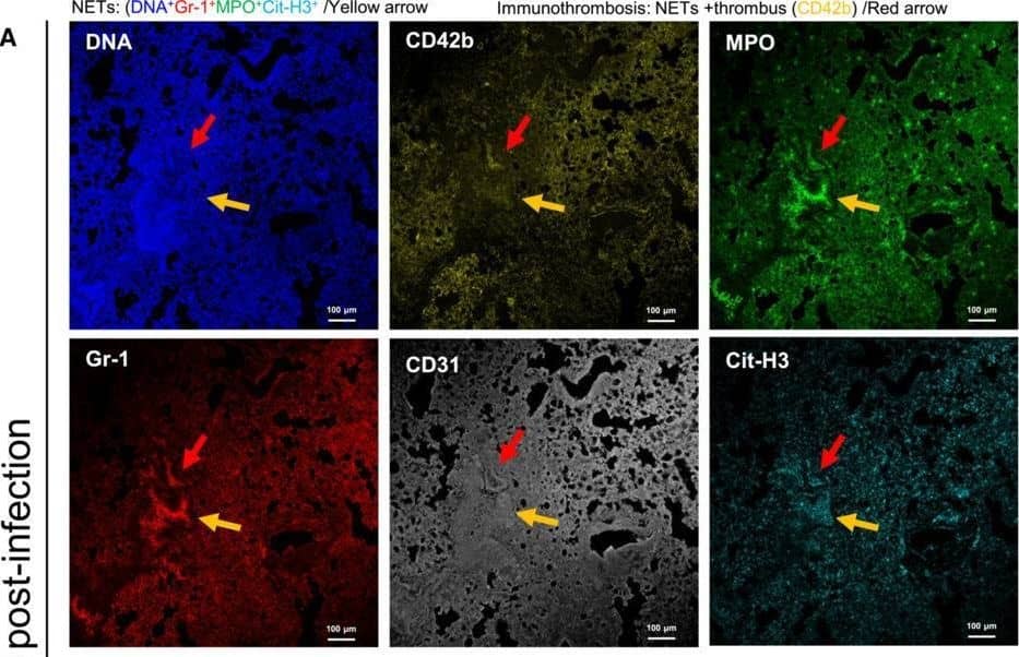 CLEC2.Fc inhibits SARS‐CoV‐2‐induced immunothrombosis in lungAAAV‐hACE2 mice were treated with saline and challenged with SARS‐CoV‐2 (8 × 104 PFU) for 5 days. Lung tissue sections were stained with DAPI (blue), anti‐MPO antibody (green), anti‐citrullinated histone H3 (Cit‐H3) antibody (red), anti‐CD42b antibody (yellow) and anti‐CD31 antibody (gray). yellow arrow: NETs (DNA+Gr‐1+MPO+Cit‐H3+); red arrow: immunothrombosis (NETs + thrombus (CD42b+)), Scale bar is 100 μm.B, CFor prophylactic treatment, CLEC2.Fc (or vehicle) was given at 1 h before virus challenge; for therapeutic treatment, CLEC2.Fc was given at 8 h post‐infection. The area of NET (colocalization area of MPO and Cit‐H3) (B) and immunothrombosis (colocalization area of Cit‐H3 and CD42b) (C) were measured using MetaMorph software.Data information: Data are mean +/- SEM from two independent experiments (saline: n = 3 for 3 d.p.i., n = 4 for 5 d.p.i.; isotype: n = 3 for 3 d.p.i., n = 4 for 5 d.p.i.; prophylactic treatment of CLEC2.Fc treatment: n = 5 for 3 d.p.i. and 5 d.p.i.; therapeutic treatment of CLEC2.Fc: n = 3 for 3 d.p.i. and 5 d.p.i.). *P < 0.05, **P < 0.01 (two‐way ANOVA).Source data are available online for this figure. Image collected and cropped by CiteAb from the following open publication (//pubmed.ncbi.nlm.nih.gov/37211986), licensed under a CC-BY license. Not internally tested by Novus Biologicals.