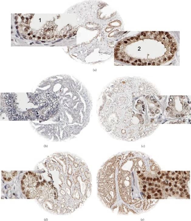 Immunohistochemistry: PNUTS/PPP1R10 Antibody [NB100-604] - Examples of PNUTS staining: (a) comparison of PNUTS staining in (1) normal & (2) cancerous prostate glands of the same TMA spot. Cancer spots with (b) lack of staining & (c) weak, (d) moderate, & (e) strong staining. Image collected & cropped by CiteAb from the following publication (//pubmed.ncbi.nlm.nih.gov/32377272), licensed under a CC-BY license. Not internally tested by Novus Biologicals.