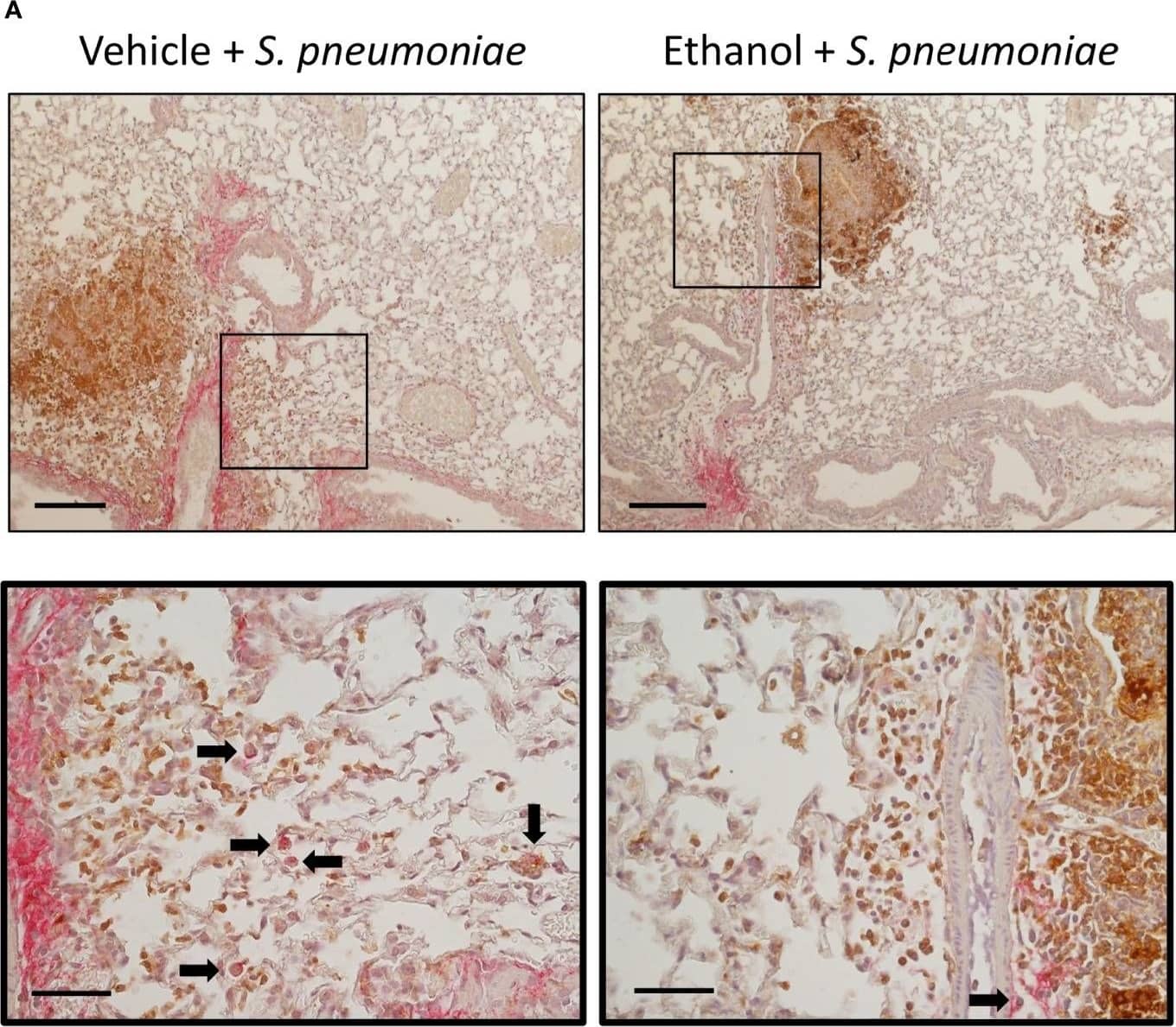 Effect of ethanol exposure on neutrophil and S. pneumoniae localization and bacterial phagocytosis after infection. (A) IHC staining was performed onformalin-fixed lung sections with antibodies against Ly6G for neutrophils (brown) and S. pneumoniae (pink) and counterstained with hematoxylin. Representative images are at 100x magnification for the top panel (scale bar = 200μm) and 400x magnification for the bottom panel (scale bar = 50 μm). (B) Percent phagocytosis of S. pneumoniae as measured by the ratio of cells with internalized bacteria to total nucleated cells. Black arrows denote cells with internalized S. pneumoniae. Data are presented as mean +/- SEM. n = 3-4 mice per group per experiment and are representative of 2 individual experiments. *p < 0.05 by unpaired t test. Image collected and cropped by CiteAb from the following open publication (//pubmed.ncbi.nlm.nih.gov/35603143), licensed under a CC-BY license. Not internally tested by Novus Biologicals.
