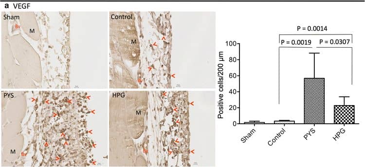 HPG induces less VEGF production, less myofibroblast differentiation and lower macrophage activation. The expression of VEGF,  alpha -SMA and MAC387 in the peritoneal tissue sections was examined using a routine immunohistochemical method. Data were a typical microscopic view of the peritoneal tissue sections in each group. a VEGF was detected using mouse monoclonal anti-VEGF antibody from Novus. Left graph a typical microscopic view, Dark brown stain VEGF-expressing cells (pointed by red arrows), Bv blood vessels, M muscle, black small bar 10 um. Right graph VEGF-expressing cells per 200 μm PM length in cross sections. Data were presented as mean +/- SD (n = 6) and were analyzed using t test. b  alpha -SMA (a myofibroblast marker) was detected using mouse monoclonal anti-alpha -SMA antibody from Sigma-Aldrich. Left graph a typical microscopic view, Dark brown stain  alpha -SMA-expressing cells or myofibroblasts (pointed by red arrows), Bv blood vessels, M muscle, black small bar 10 um. Right graph  alpha -SMA-expressing cells per 200 μm PM length in cross sections. Data were presented as mean +/- SD (n = 6) and were analyzed using t test. c Macrophages were detected using mouse monoclonal anti-MAC387 antibody from Santa Cruz Biotech. Left graph a typical microscopic view, Dark brown stain MAC387-expressing cells or macrophages (pointed by red arrows), M muscle, black small bar 10 um. Right graph MAC387-expressing cells per 200 μm PM length in cross sections. Data were presented as mean +/- SD (n = 6) and were analyzed using t test Image collected and cropped by CiteAb from the following open publication (//pubmed.ncbi.nlm.nih.gov/27964722), licensed under a CC-BY license. Not internally tested by Novus Biologicals.