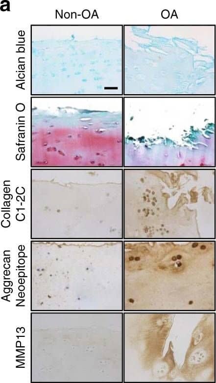 NUDT7, a peroxisomal gene, is suppressed during osteoarthritis (OA) pathogenesis. a Staining with Alcian blue or safranin O and immunohistochemistry of Collagen C1-2C, Aggrecan Neoepitope, and matrix metalloproteinase (MMP)-13 using non-OA and OA cartilage from human patients with OA pathogenesis (n = 5 per group). Scale bar, 50 μm. b Transcription levels of 94 peroxisome-related genes in human OA chondrocytes (n = 15 per group) compared with those in normal chondrocytes (n = 8 per group). c Immunostaining of NUDT7, and the mRNA level of NUDT7 in human OA chondrocytes (n = 20 per group) compared with that in normal chondrocytes (n = 13 per group). Scale bar, 50 μm. d Transcription level of NUDT7 in normal chondrocytes infected with lentivirus containing each NUDT7 short hairpin RNA (shRNA). e Transcription level of matrix-degrading enzymes in normal chondrocytes infected with lentivirus containing an NUDT7 shRNA (shNUDT7) (n = 3). f, g Analysis of cell proliferation (n = 4 per group) and apoptotic cell death (n = 6 per group) in normal chondrocytes infected with lentivirus containing NUDT7 or NUDT7 shRNA. h, i Activities of catalase and glutathione peroxidase (GPx) in normal chondrocytes infected with lentivirus containing NUDT7 or NUDT7 shRNA (n = 6 per group). Values are means + s.d. An unpaired Student’s t test was used for statistical analysis. *P < 0.05, **P < 0.01, ***P < 0.001, ****P < 0.0001 Image collected and cropped by CiteAb from the following open publication (//pubmed.ncbi.nlm.nih.gov/30143643), licensed under a CC-BY license. Not internally tested by Novus Biologicals.