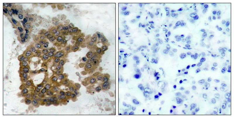 Immunohistochemistry-Paraffin: AKT2 [p Ser474] Antibody [NB100-81780] - Immunohistochemical analysis of paraffin-embedded human lung carcinoma tissue using NB100-81780 (left) or the same antibody preincubated with blocking peptide (right).
