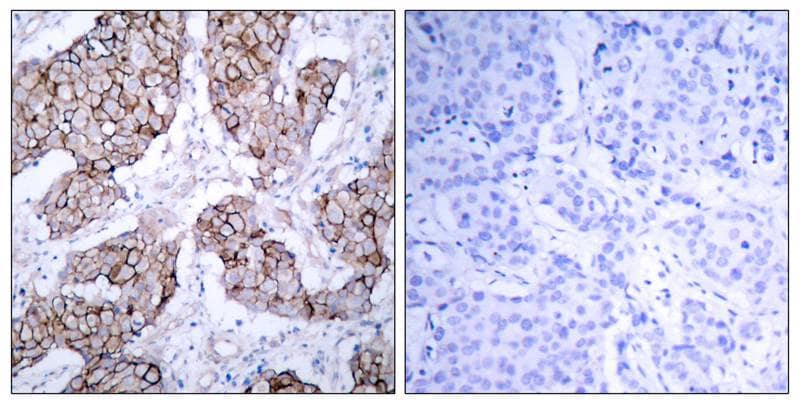 <b>Biological Strategies Validation. </b>Immunohistochemistry-Paraffin: EGFR [p Tyr1092] Antibody [NB100-81894] - Analysis of paraffin- embedded human breast carcinoma tissue using NB100-81894(left) or the same antibody preincubated with blocking peptide(right).