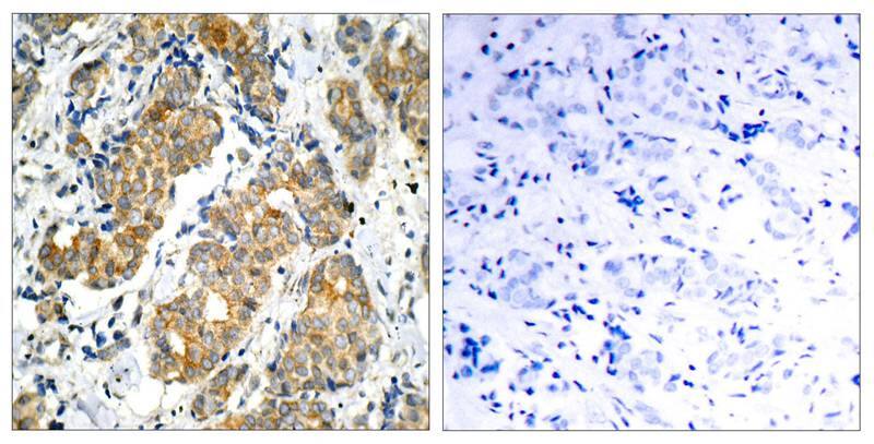 Immunohistochemistry-Paraffin: GSK-3 alpha Antibody [NB100-81943] - Analysis of paraffin- embedded human breast carcinoma tissue using NB100-81943(left) or the same antibody preincubated with blocking peptide (right).