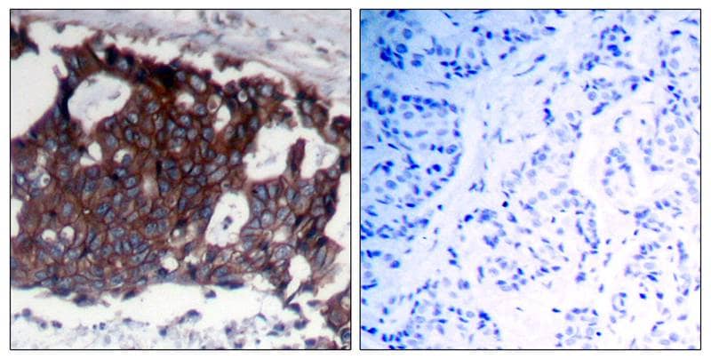 Immunohistochemistry-Paraffin: ErbB2/Her2 Antibody [NB100-81957] - Staining of paraffin-embedded human breast carcinoma tissue using NB100-81957(left) or the same antibody preincubated with blocking peptide(right).