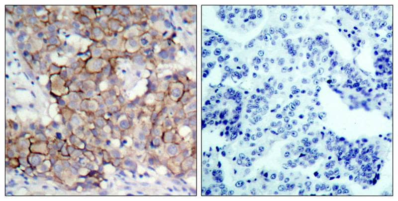 <b>Biological Strategies Validation. </b>Immunohistochemistry-Paraffin: ErbB2/Her2 [p Tyr877] Antibody [NB100-81961] - Immunohistochemical analysis of paraffin-embedded human breast carcinoma tissue, using NB100-81961 incubated with blocking peptide (right)