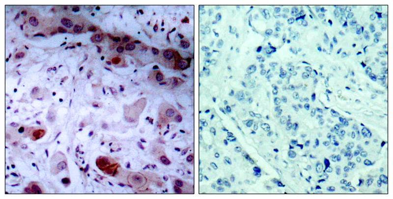 Immunohistochemistry-Paraffin: Jak1 [p Tyr1022] Antibody [NB100-82005] - Analysis of paraffin-embedded human breast carcinoma tissue, using NB100-82005(left) or the same antibody preincubated with blocking peptide (right).