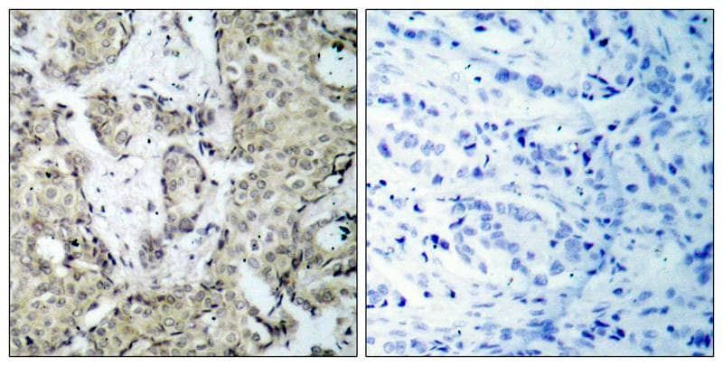 Immunohistochemistry-Paraffin: MKK3/MEK3 [p Ser189] Antibody [NB100-82048] - Immunohistochemical analysis of paraffin- embedded human breast carcinoma tissue, using NB100-82048(left) or the same antibody preincubated with blocking peptide (right).
