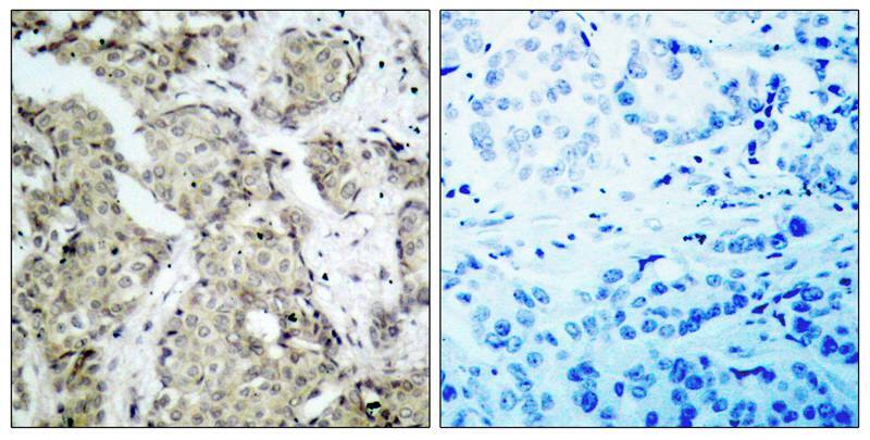 <b>Biological Strategies Validation. </b>Immunohistochemistry-Paraffin: MKK6/MEK6 [p Ser207] Antibody [NB100-82050] - Immunohistochemical analysis of paraffin- embedded human breast carcinoma tissue, using NB100-82050(left) or the same antibody preincubated with blocking peptide (right).