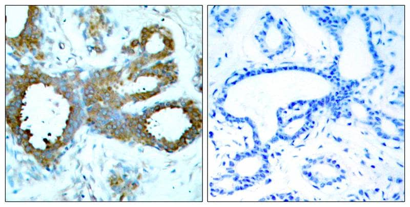 Immunohistochemistry-Paraffin: PAK1/2/3 [p Thr423, p Thr402, p Thr421] Antibody [NB100-82131] - Immunohistochemical analysis of paraffin-embedded human breast carcinoma tissue, using NB100-82131(left) or the same antibody preincubated with blocking peptide(right).