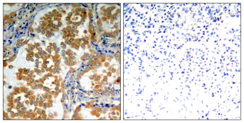Immunohistochemistry-Paraffin: PKC zeta Antibody [NB100-82147] - Immunohistochemical analysis of paraffin-embedded human lung carcinoma tissue using NB100-82147.
